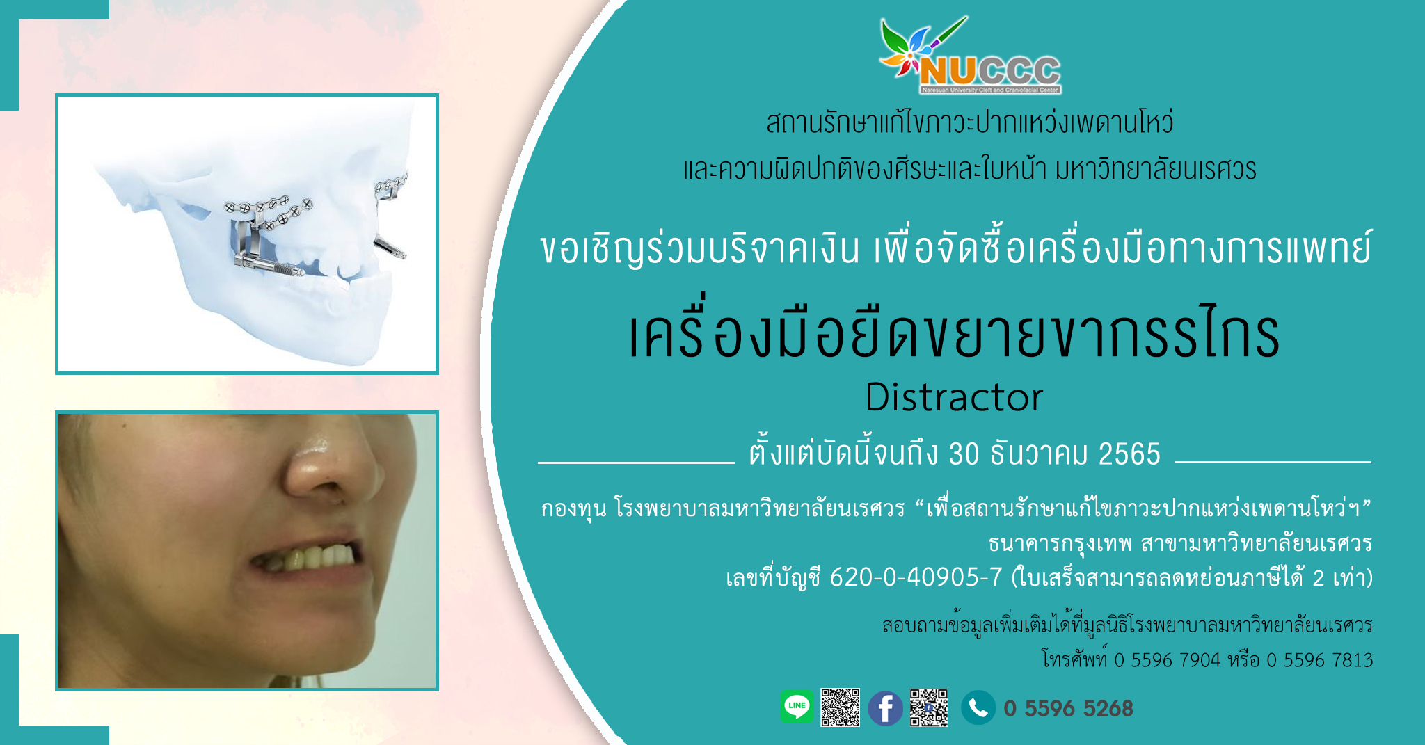 ขอเชิญร่วมบุญ จัดซื้อเครื่อมือแพทย์ เครื่องมือยืดขยายขากรรไกร