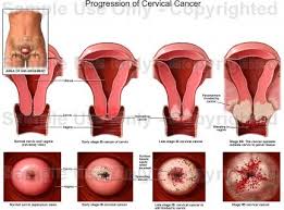 มะเร็งเยื่อบุโพรงมดลูก (Endometrial cancer)
