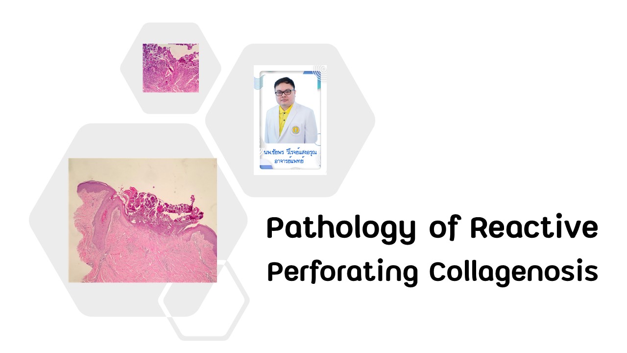 Pathology of Reactive Perforating Collagenosis