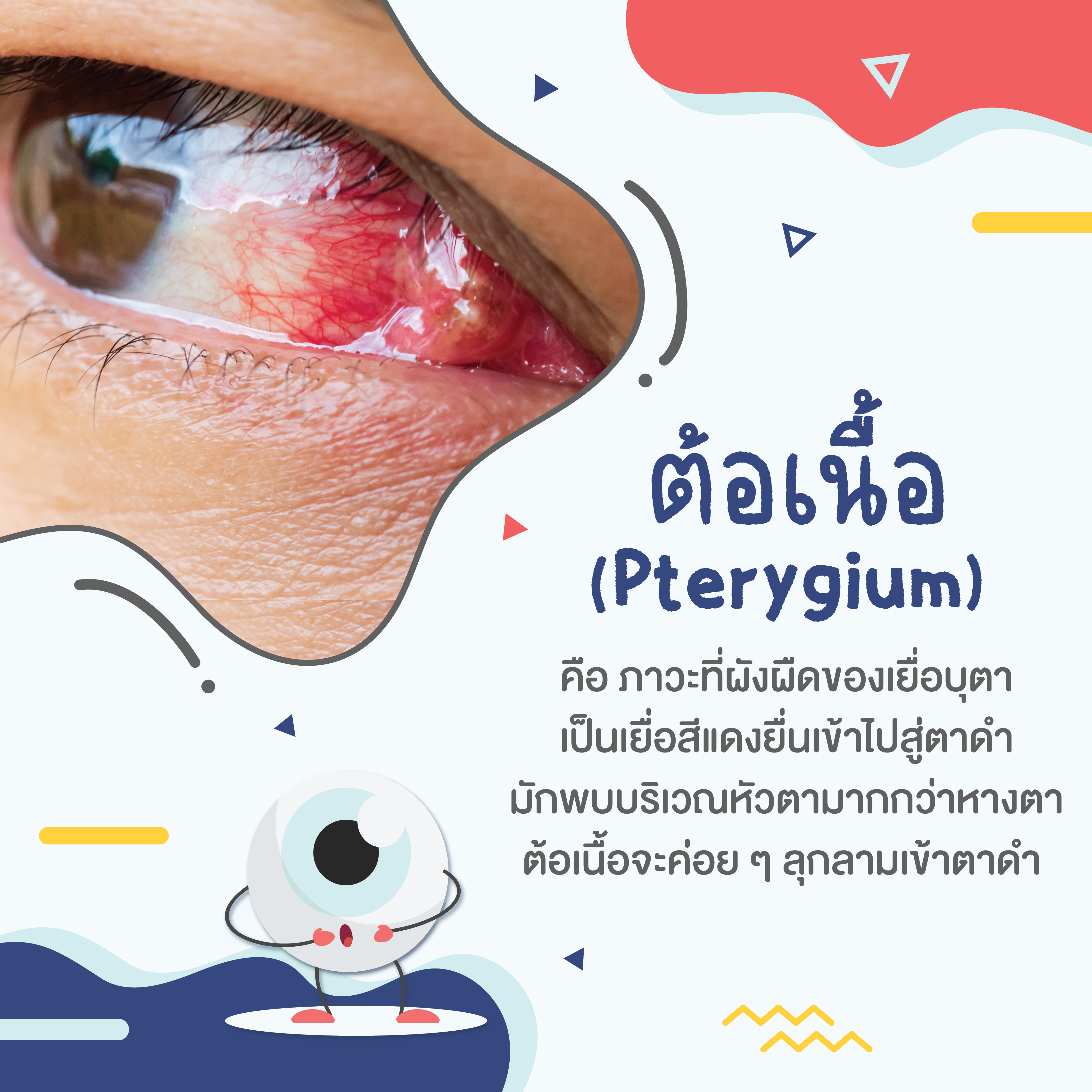 ต้อเนื้อ (Pterygium)