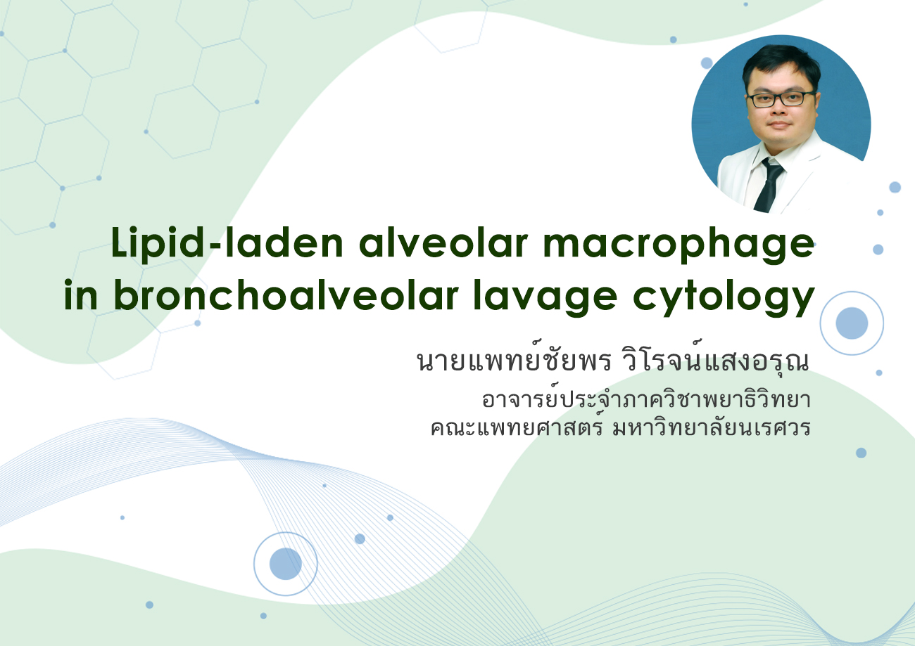 Lipid-laden alveolar macrophage in bronchoalveolar lavage cytology