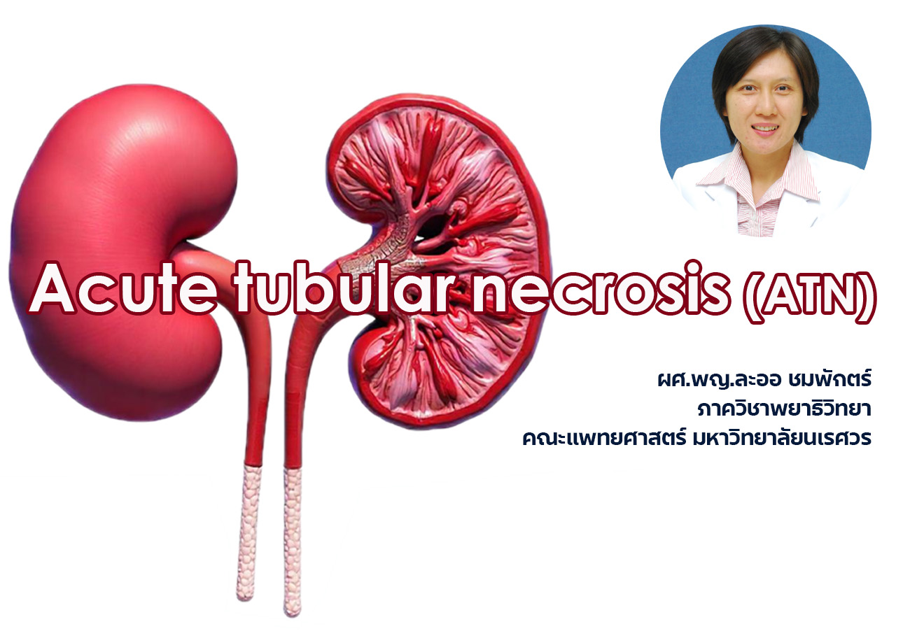 Acute tubular necrosis (ATN) 